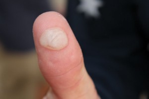Blistered finger