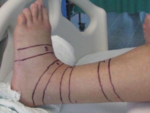 Lines around Randy's leg to measure the swelling